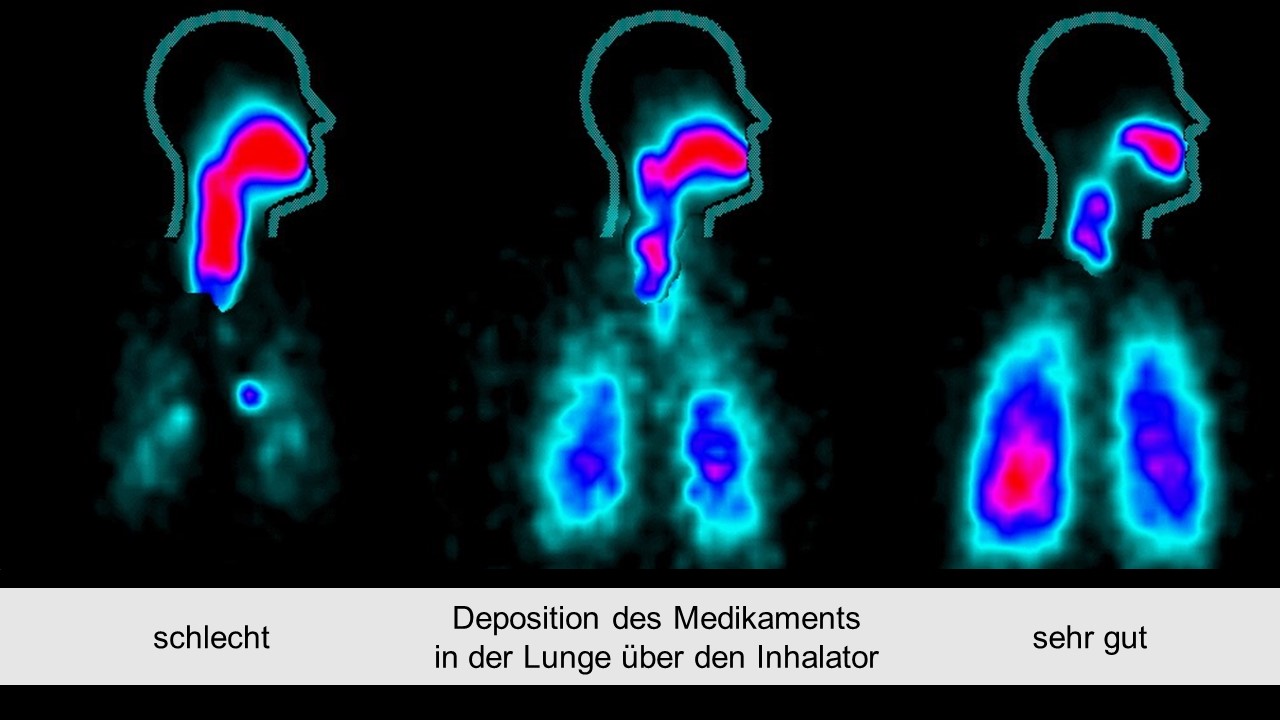 Wirkungsgrad der Inhalation | PRAXIS DR. BERGMANN